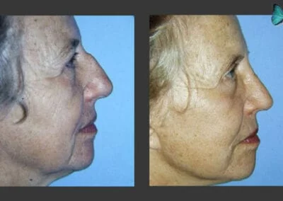 Scarless Rhinoplasty Before and After by Leading Los Angeles Rhinoplasty Surgeon in Beverly Hills Dr. Malcolm Lesavoy.