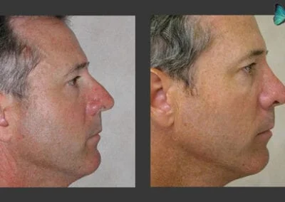 Scarless Rhinoplasty Before and After by Leading Los Angeles Rhinoplasty Surgeon in Beverly Hills Dr. Malcolm Lesavoy.