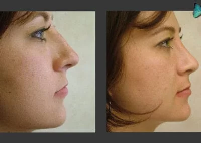 Scarless Rhinoplasty Before and After by Leading Los Angeles Rhinoplasty Surgeon in Beverly Hills Dr. Malcolm Lesavoy.