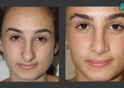 Scarless Rhinoplasty Before and After by Leading Los Angeles Rhinoplasty Surgeon in Beverly Hills Dr. Malcolm Lesavoy.
