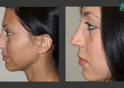 Scarless Rhinoplasty Before and After by Leading Los Angeles Rhinoplasty Surgeon in Beverly Hills Dr. Malcolm Lesavoy.