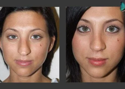Scarless Rhinoplasty Before and After by Leading Los Angeles Rhinoplasty Surgeon in Beverly Hills Dr. Malcolm Lesavoy.