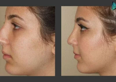 Scarless Rhinoplasty Before and After by Leading Los Angeles Rhinoplasty Surgeon in Beverly Hills Dr. Malcolm Lesavoy.