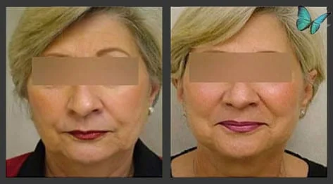 Facelift before and after photos by Beverly Hills Face Lift Specialist Dr. Malcolm Lesavoy in Los Angles.
