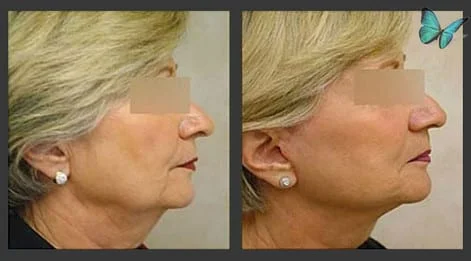 Facelift before and after photos by Beverly Hills Facelift Plastic Surgery Specialist Dr. Malcolm Lesavoy in Los Angeles.