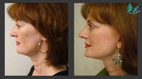 Facelift before and after photos by Beverly Hills Facelift Specialist Dr. Malcolm Lesavoy.