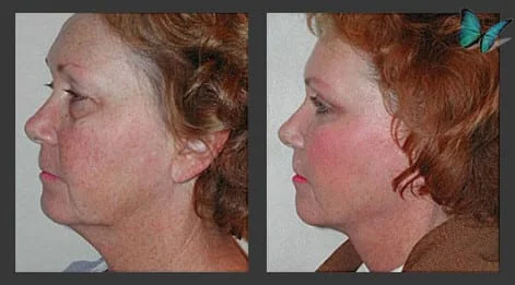 Facelift and Neck lift before after photos by Beverly Hills Facelift Specialist Dr. Malcolm Lesavoy in Los Angeles.