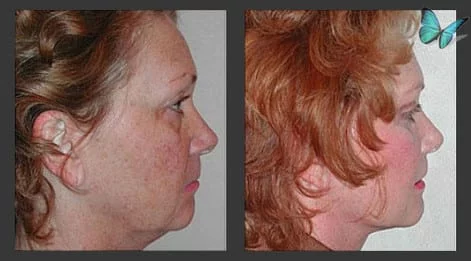 Face and Neck Lift Before After Photos by Los Angeles Facelift Specialist Dr. Malcolm Lesavoy in Los Angeles.
