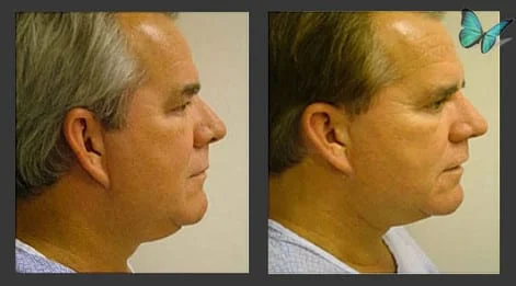 Male Facelift and Neck lift before and after photos by Beverly Hills Facelift Specialist Dr. Malcolm Lesavoy.