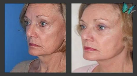 Facelift Before and After Photos by Los Angeles Facelift Expert Dr. Malcolm Lesavoy in Los Angeles.