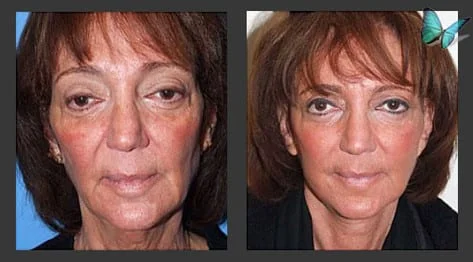 Facelift Before and After Photos by Beverly Hills Facelift Surgeon Dr. Malcolm Lesavoy - leading Los Angeles Plastic Surgeon.