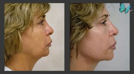 Local Anesthesia Face Lift Before and After Photos by Beverly Hills Face lift Specialist Dr. Malcolm Lesavoy.