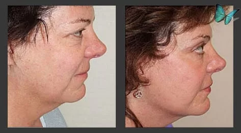 Facelift Before and After Photos by Beverly Hills Face lift Specialist Dr. Malcolm Lesavoy in Los Angeles.