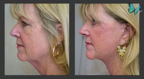 Local Anesthesia Facelift Before and After Photos by Beverly Hills Facelift Specialist Dr. Malcolm Lesavoy in Los Angeles.
