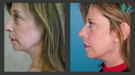 Facelift Before and After Photos by Beverly Hills Facelift Specialist Dr. Malcolm Lesavoy in Los Angeles.