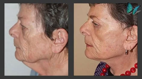 Face and Neck lift before and after photos by Beverly Hills Facelift Specialist Dr. Malcolm Lesavoy in Los Angeles.