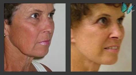 Face lift Before and After Photos by Beverly Hills Facelift Specialist Dr. Malcolm Lesavoy in Los Angeles.