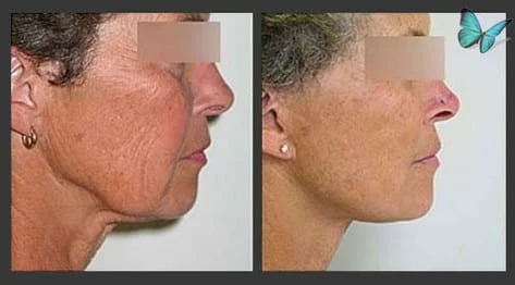 Face and Neck lift before and after photos by Beverly Hills Facelift Specialist Dr. Malcolm Lesavoy in Los Angeles.
