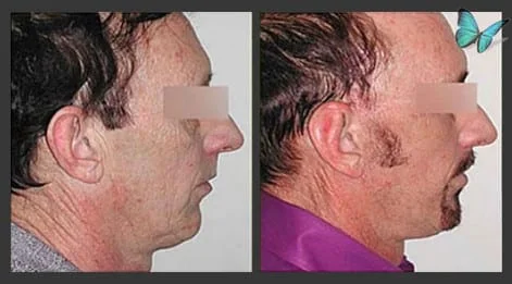Male Face and Neck lift before and after photos by Beverly Hills Facelift Specialist Dr. Malcolm Lesavoy in Los Angeles.