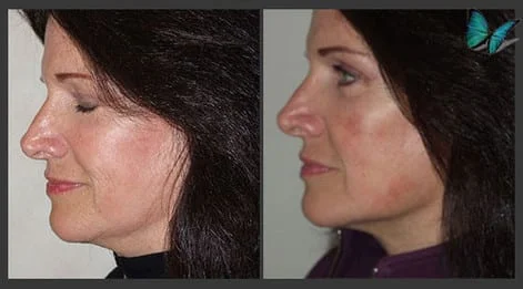 Face lift Before and After Photos by Beverly Hills Facelift Specialist Dr. Malcolm Lesavoy in Los Angeles.