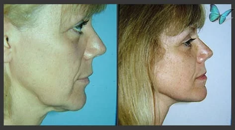Face and Neck Lift Before and After Photos by Beverly Hills Facelift Specialist Dr. Malcolm Lesavoy in Los Angeles.