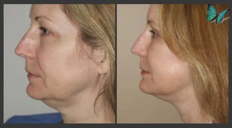 Face and Neck Lift Specialist Beverly Hills Los Angeles Beverly Hills Facelift Specialist Dr. Malcolm Lesavoy.
