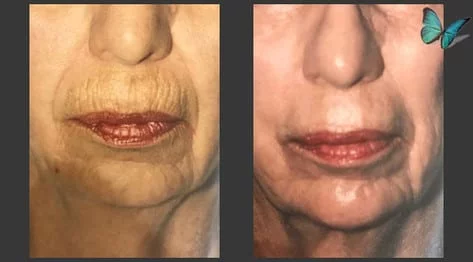 Skin Resurfacing with Dermabrasion of the face before and after by Beverly Hills Plastic Surgeon Dr. Malcolm Lesavoy.