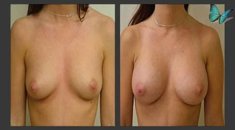 Breast Augmentation with Armpit Incision Before and After by Leading Los Angeles Plastic Surgeon in Beverly Hills Dr. Malcolm Lesavoy.