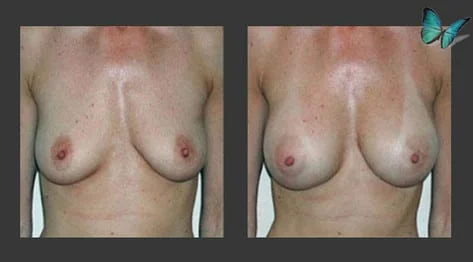 Breast Augmentation before and after photos by leading Los Angeles Plastic Surgeon in Beverly Hills Dr. Malcolm Lesavoy.