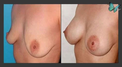 Breast Augmentation before and after photos by leading Los Angeles Plastic Surgeon in Beverly Hills Dr. Malcolm Lesavoy.