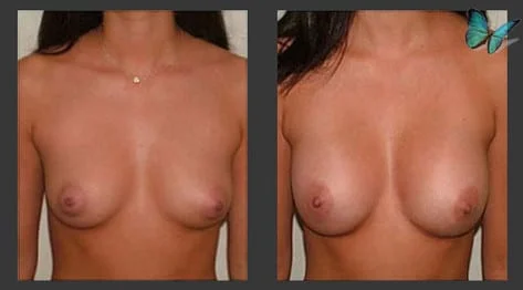 Breast Augmentation before and after photos by leading Los Angeles Plastic Surgeon in Beverly Hills Dr. Malcolm Lesavoy.