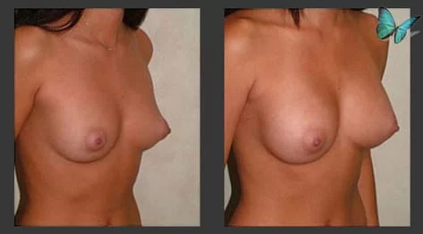 Breast Augmentation before and after photos by leading Los Angeles Plastic Surgeon in Beverly Hills Dr. Malcolm Lesavoy.