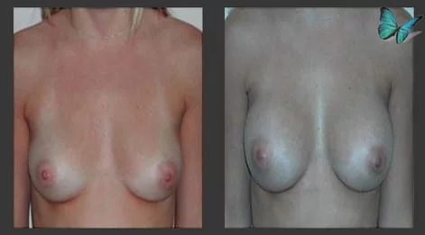 Breast Augmentation before and after photos by leading Los Angeles Plastic Surgeon in Beverly Hills Dr. Malcolm Lesavoy.