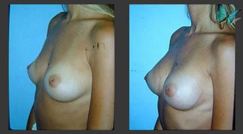 Breast Augmentation before and after photos by leading Los Angeles Plastic Surgeon in Beverly Hills Dr. Malcolm Lesavoy.