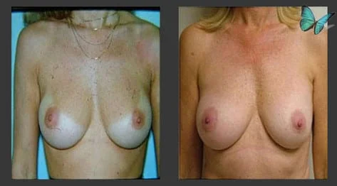 Breast Augmentation before and after photos by leading Los Angeles Plastic Surgeon in Beverly Hills Dr. Malcolm Lesavoy.