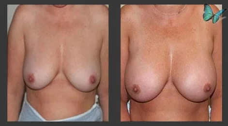 Breast Augmentation before and after photos by leading Los Angeles Plastic Surgeon in Beverly Hills Dr. Malcolm Lesavoy.
