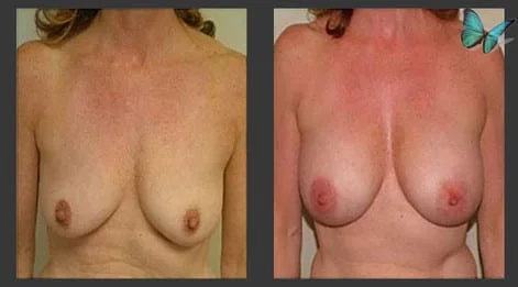 Breast Augmentation before and after photos by leading Los Angeles Plastic Surgeon in Beverly Hills Dr. Malcolm Lesavoy.
