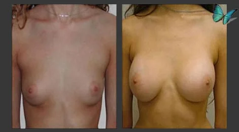 Breast Augmentation with Armpit Incision Before and After by Leading Los Angeles Plastic Surgeon in Beverly Hills Dr. Malcolm Lesavoy.