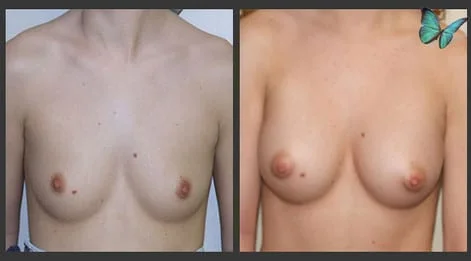Breast Augmentation before and after photos by leading Los Angeles Plastic Surgeon in Beverly Hills Dr. Malcolm Lesavoy.