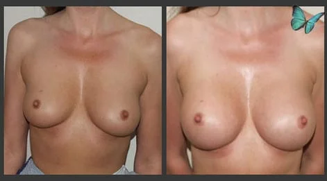 Breast Augmentation before and after photos by leading Los Angeles Plastic Surgeon in Beverly Hills Dr. Malcolm Lesavoy.