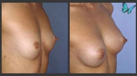 Breast Augmentation before and after photos by leading Los Angeles Plastic Surgeon in Beverly Hills Dr. Malcolm Lesavoy.