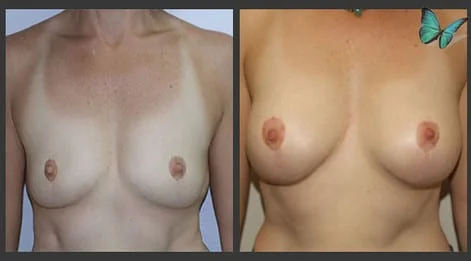Breast Augmentation before and after photos by leading Los Angeles Plastic Surgeon in Beverly Hills Dr. Malcolm Lesavoy.