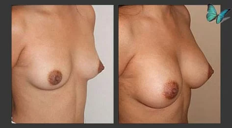 Breast Augmentation with Armpit Incision Before and After by Leading Los Angeles Plastic Surgeon in Beverly Hills Dr. Malcolm Lesavoy.