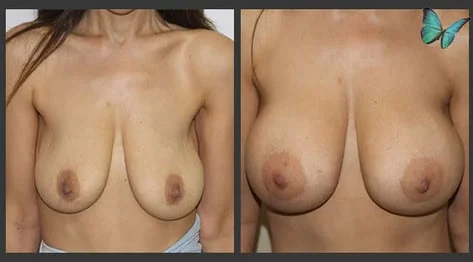 Breast Augmentation before and after photos by leading Los Angeles Plastic Surgeon in Beverly Hills Dr. Malcolm Lesavoy.