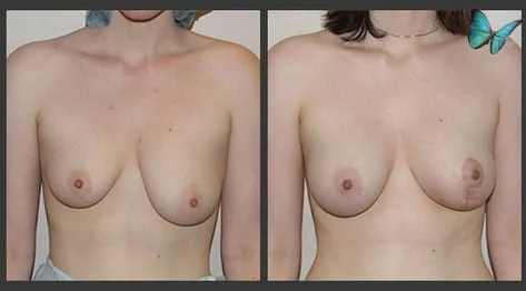 Breast Asymmetry Surgery by Beverly Hills Breast Surgery Specialist Dr. Malcolm Lesavoy