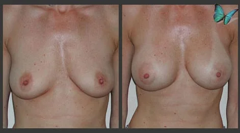 Breast Augmentation before and after photos by leading Los Angeles Plastic Surgeon in Beverly Hills Dr. Malcolm Lesavoy.