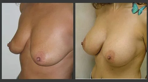 Breast Augmentation before and after photos by leading Los Angeles Plastic Surgeon in Beverly Hills Dr. Malcolm Lesavoy.