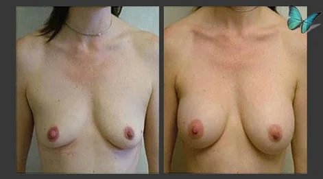 Breast Augmentation before and after photos by leading Los Angeles Plastic Surgeon in Beverly Hills Dr. Malcolm Lesavoy.