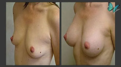 Breast Augmentation before and after photos by leading Los Angeles Plastic Surgeon in Beverly Hills Dr. Malcolm Lesavoy.