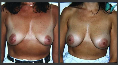 Breast Augmentation before and after photos by leading Los Angeles Plastic Surgeon in Beverly Hills Dr. Malcolm Lesavoy.